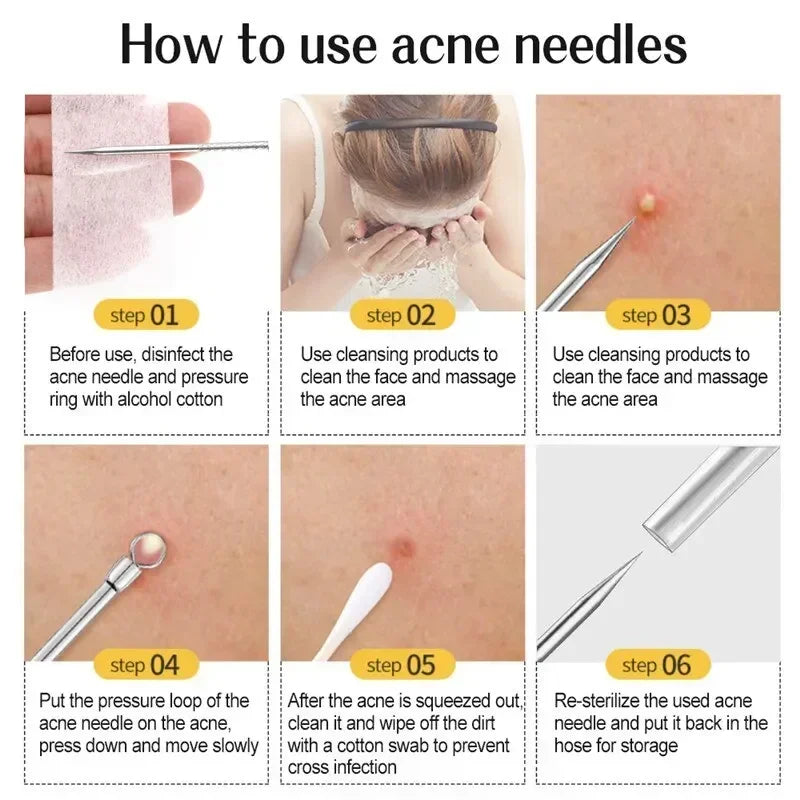 11-Piece Acne & Blackhead Remover Kit – Ultra-Fine Tweezers, Extractor Tools & Facial Cleaning Needles